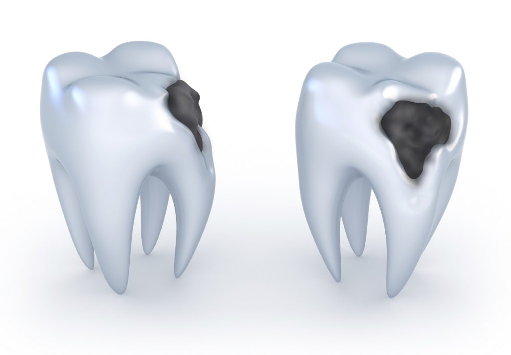 შექმნილია ახალი სამკურნალო საშუალება, რომელიც კბილის ღრმულებს თავისით აღადგენს