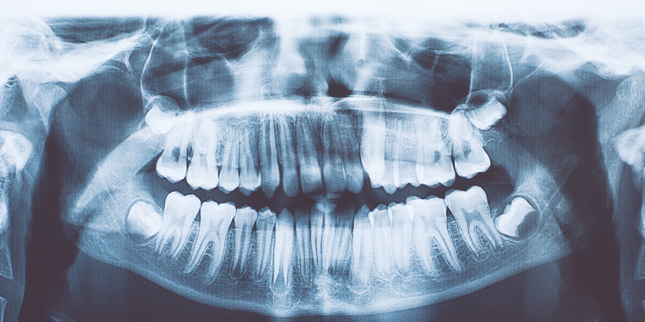 7 წლის ბიჭს სტომატოლოგებმა პირის ღრუდან 500-ზე მეტი კბილი ამოუღეს