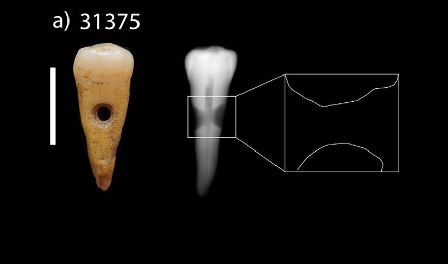 აღმოჩენილია უძველეს ადამიანთა კბილები, რომლებსაც ნეოლითის ხანაში სამკაულებად იყენებდნენ