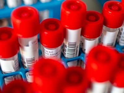 В регионе Кахети зарегистрирован случай коронавируса, инфицированный работает на пограничном пункте Ларси