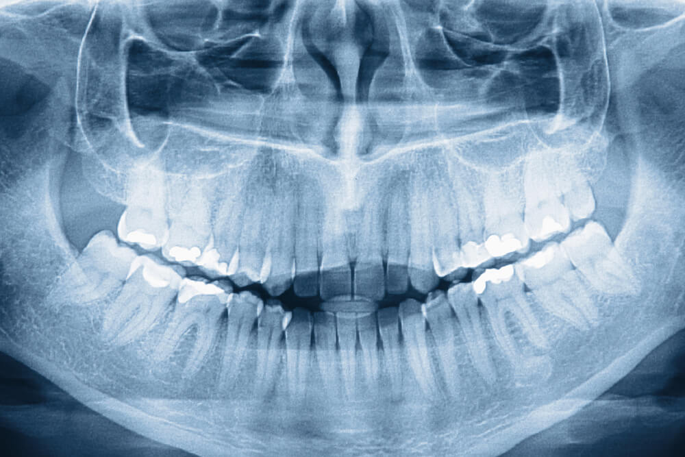 კბილების კრაჭუნი — რას ნიშნავს, რა იწვევს და რა უნდა მოიმოქმედოთ #1tvმეცნიერება
