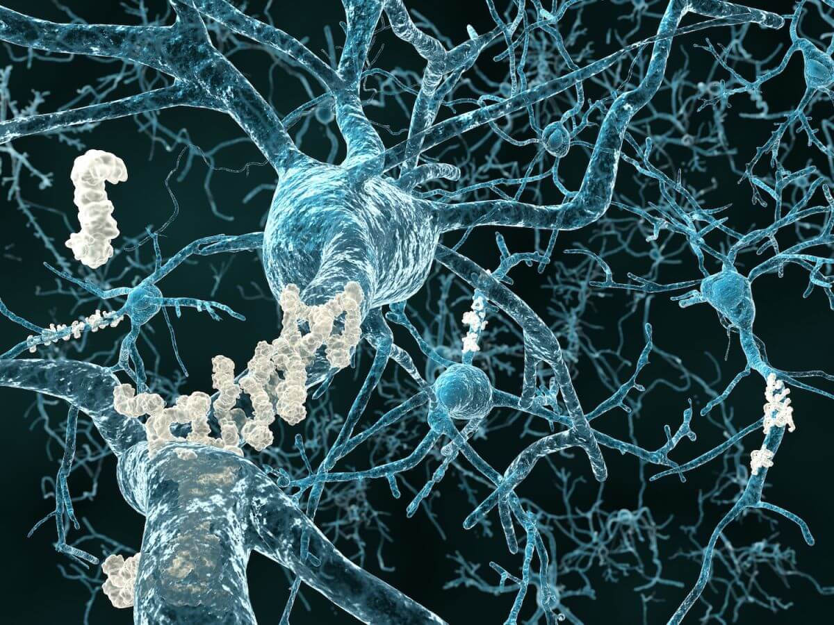 სულ უფრო მეტი მტკიცებულება მიუთითებს, რომ ალცჰაიმერის დაავადებას ორი საკმაოდ გავრცელებული ვირუსის „შეამხანაგება“ იწვევს — #1tvმეცნიერება