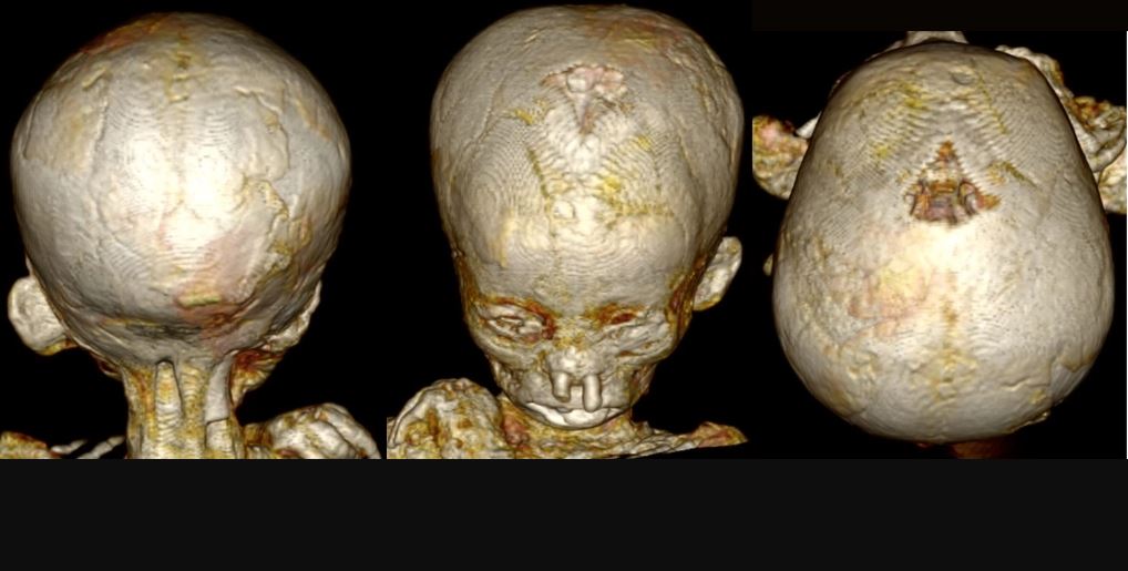 ძველეგვიპტელი ბავშვების მუმიები ერთი უძველესი დაავადების ფართოდ გავრცელებაზე მიუთითებს — #1tvმეცნიერება
