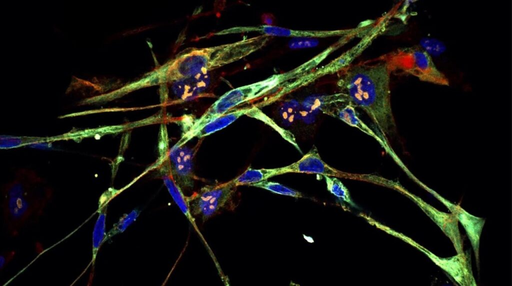 აგრესიული კიბოს უჯრედები მეცნიერებმა ჯანმრთელ უჯრედებად გარდაქმნეს — #1tvმეცნიერება
